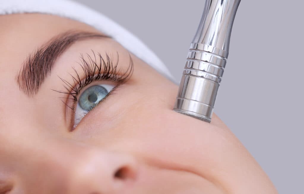 Microdermabrasion treatment