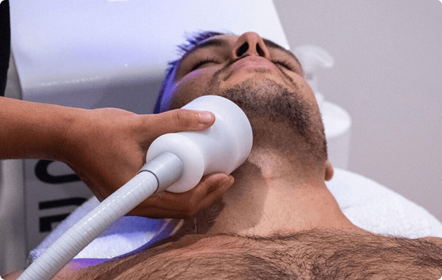 RF Microneedling