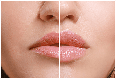 Lip Enhancement