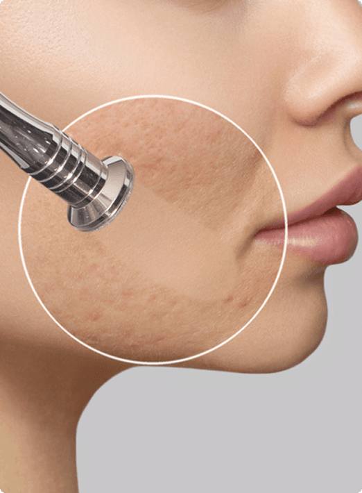 Address Mild Scarring and Sun Damage